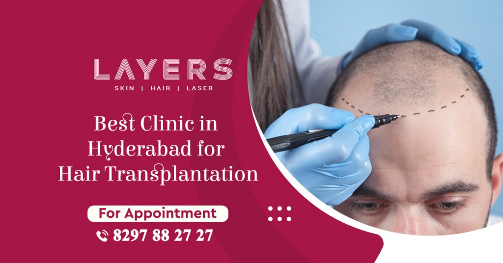 Best Clinic in Hyderabad for Hair Transplantation