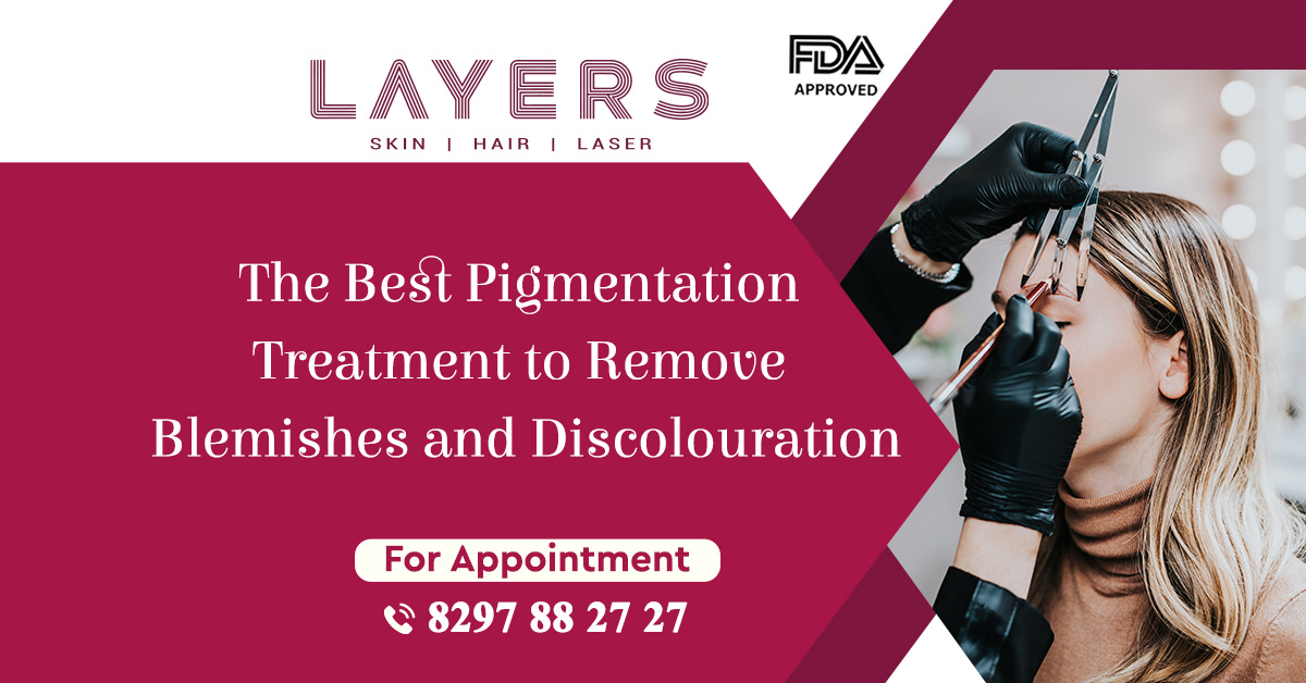 best treatment for pigmentation