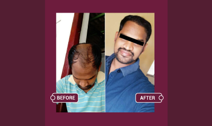 Hair Transplant Treatment in Hyderabad at Skinbliss Clinic