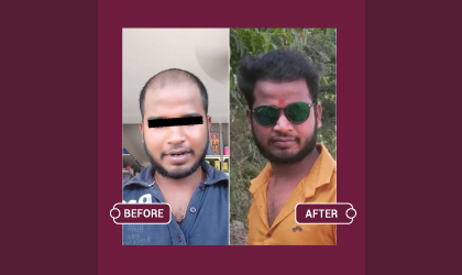 Hair Transplant Before & After images
