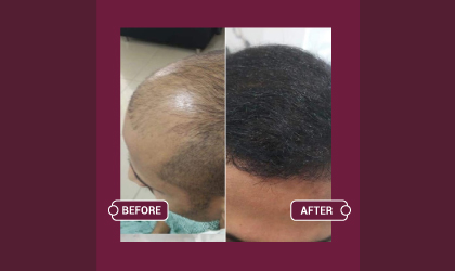 Hair Transplant Before & After images