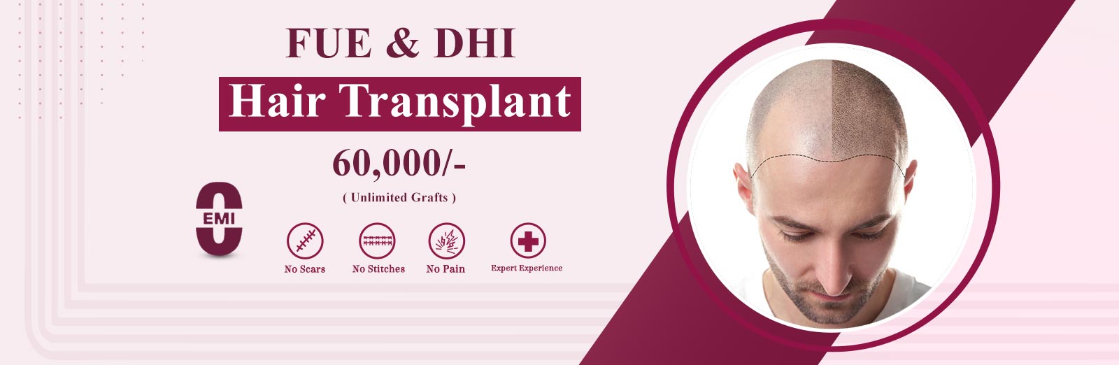 Hair Transplantation Treatment in Hyderabad