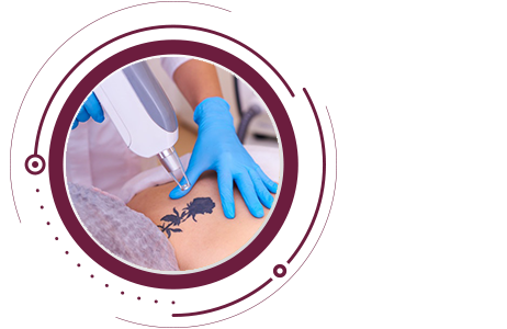 NeoSkin Cosmetology Centre  Indias Most Trusted Skin  Hair Clinic  offering permanent laser tattoo removal services in Hyderabad Book an  appointment now Visit httpneoskinintattooremovalinhyderabadindiacostphp   Facebook