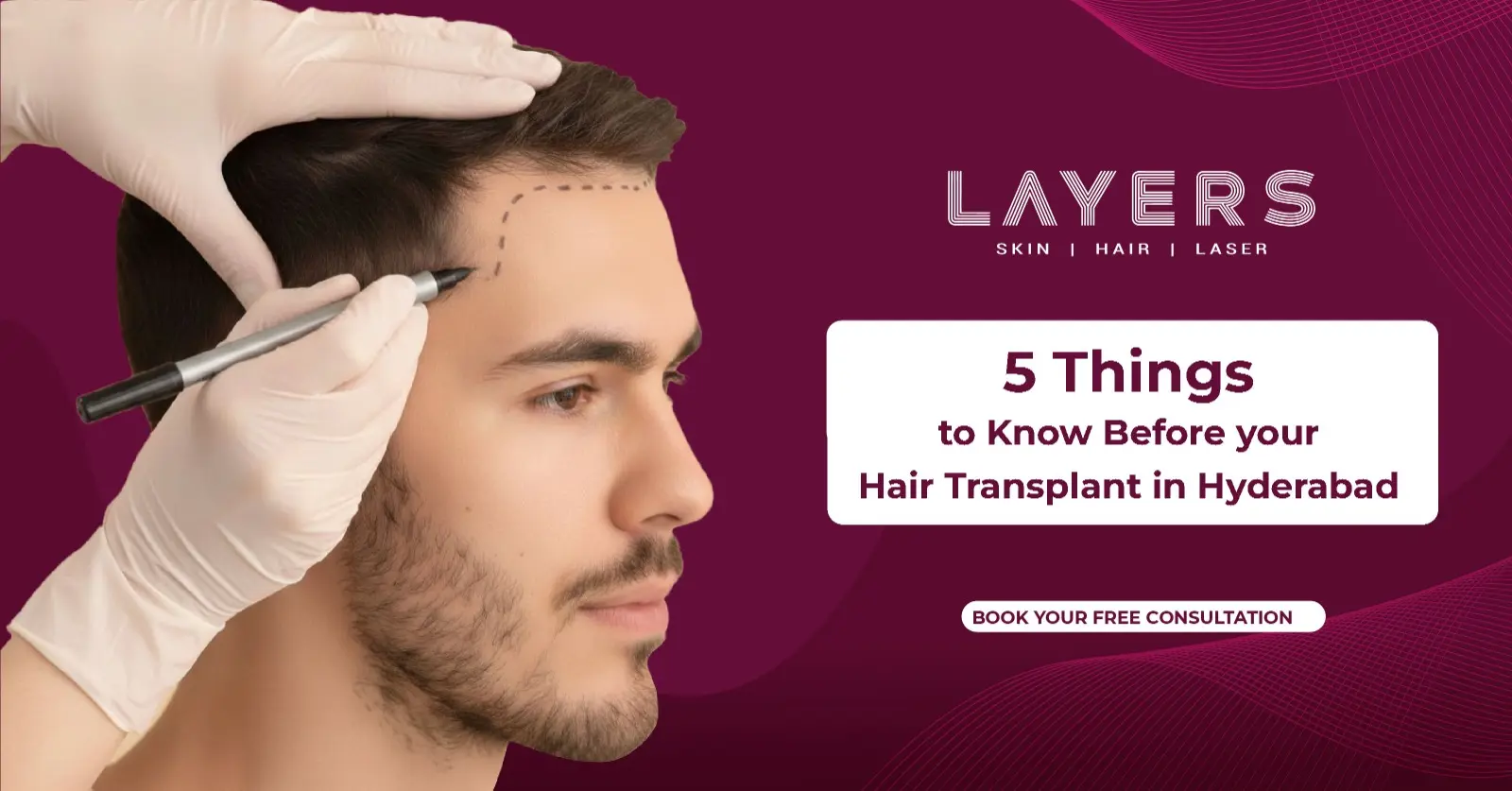 5 Things to Know Before Your Hair Transplant in Hyderabad
