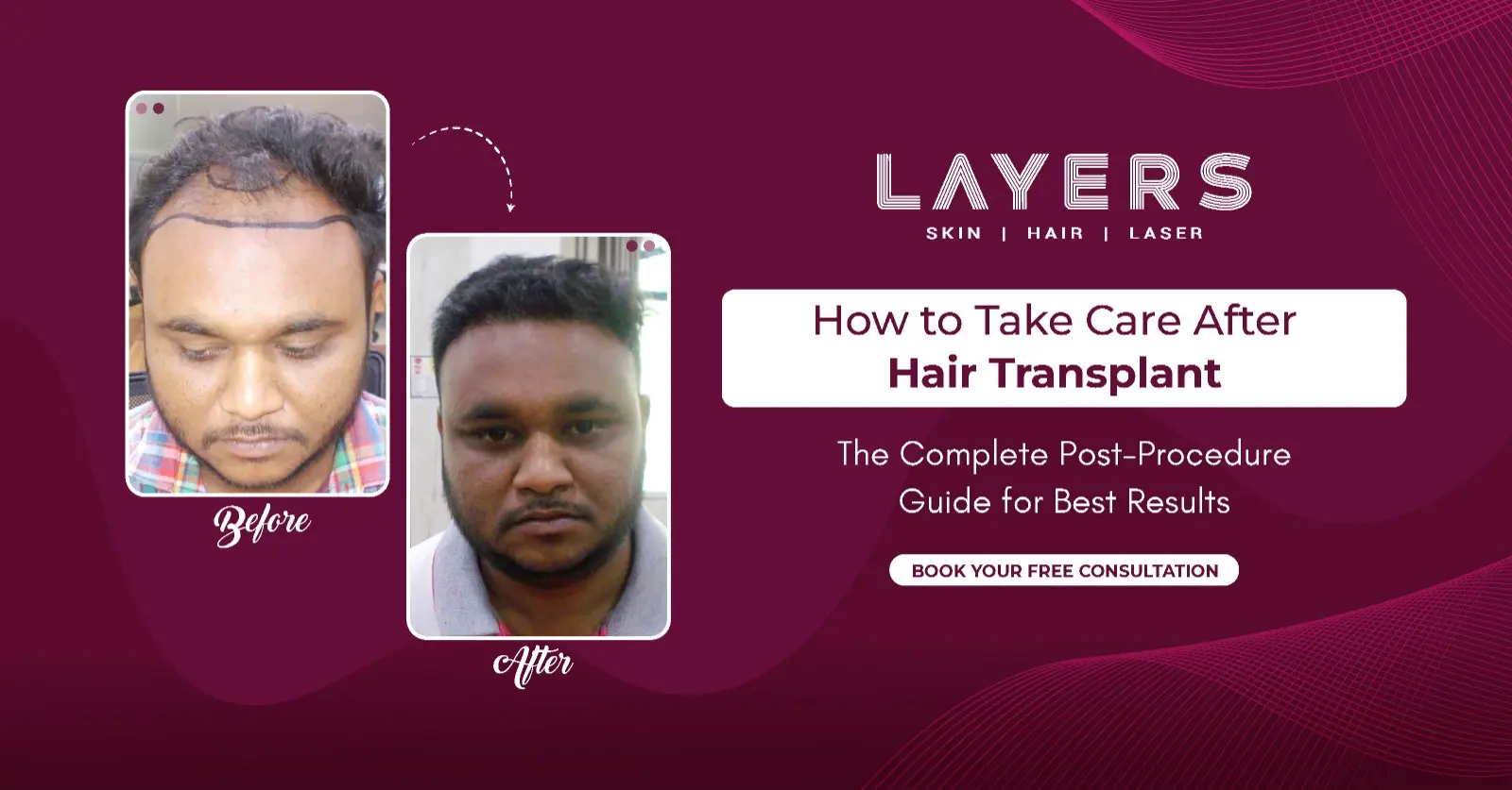 After Hair Transplant