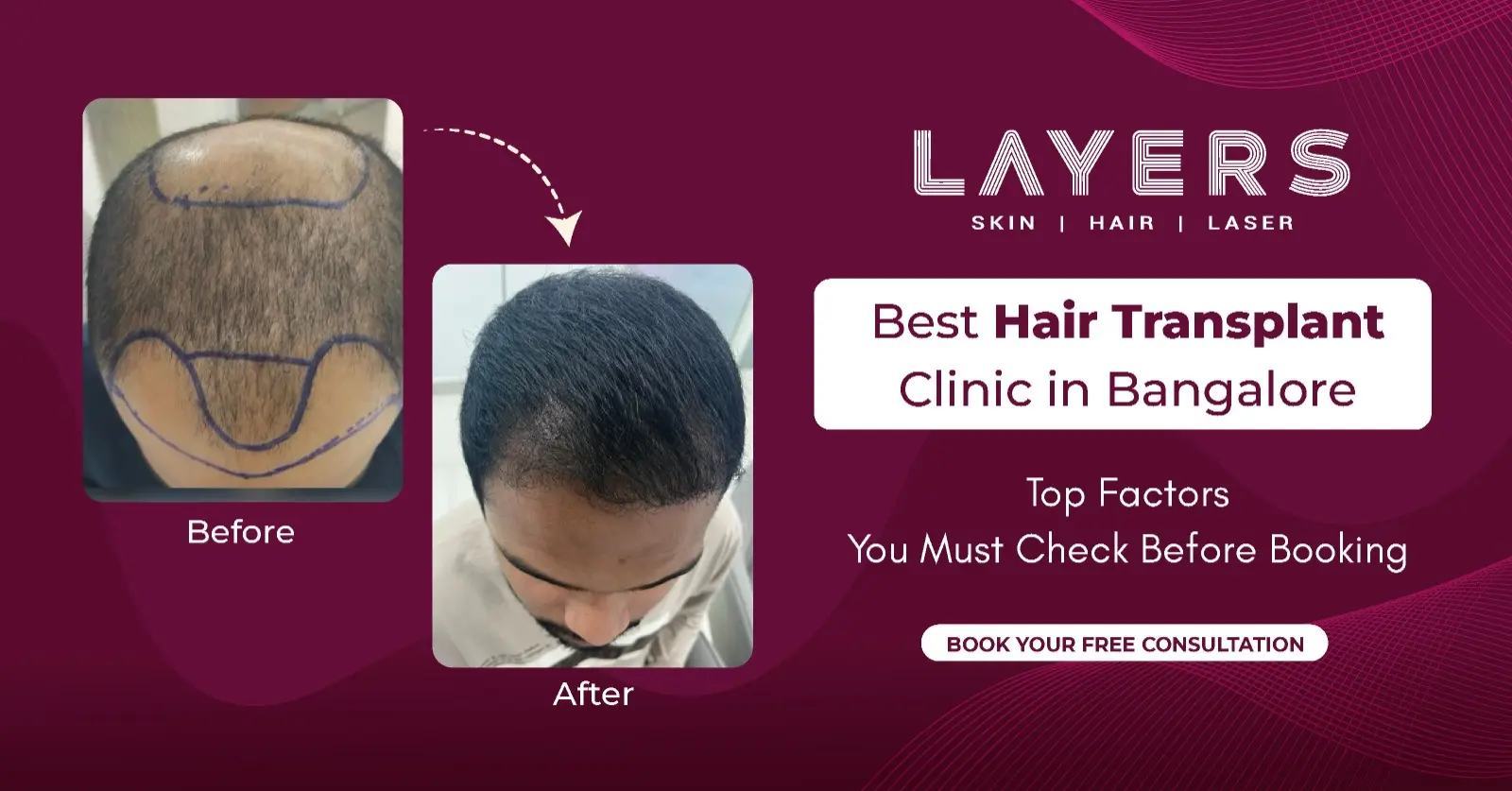 Best Hair Transplant Clinic in Bangalore: Top Factors You Must Check Before Booking