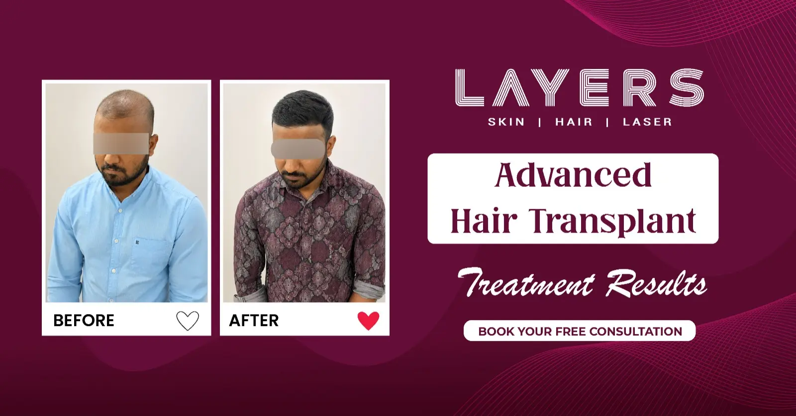 Best Hair Transplantation Before and After Results