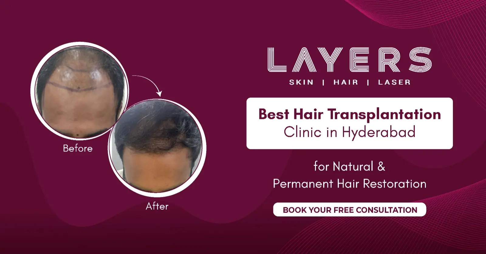Best Hair Transplantation Clinic in Hyderabad for Natural & Permanent Hair Restoration
