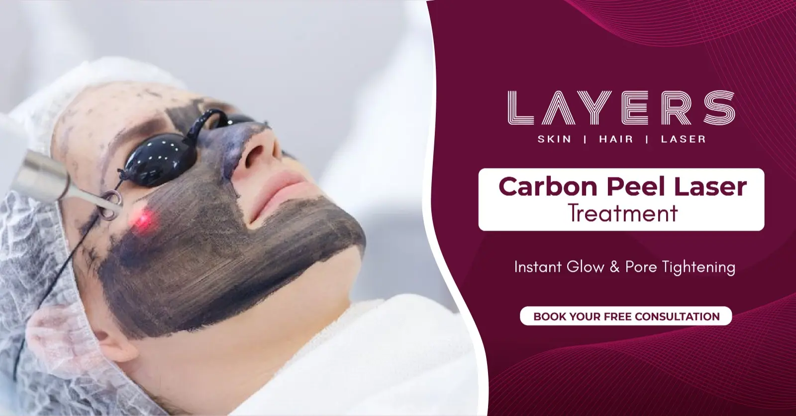 Carbon Peel Laser Treatment