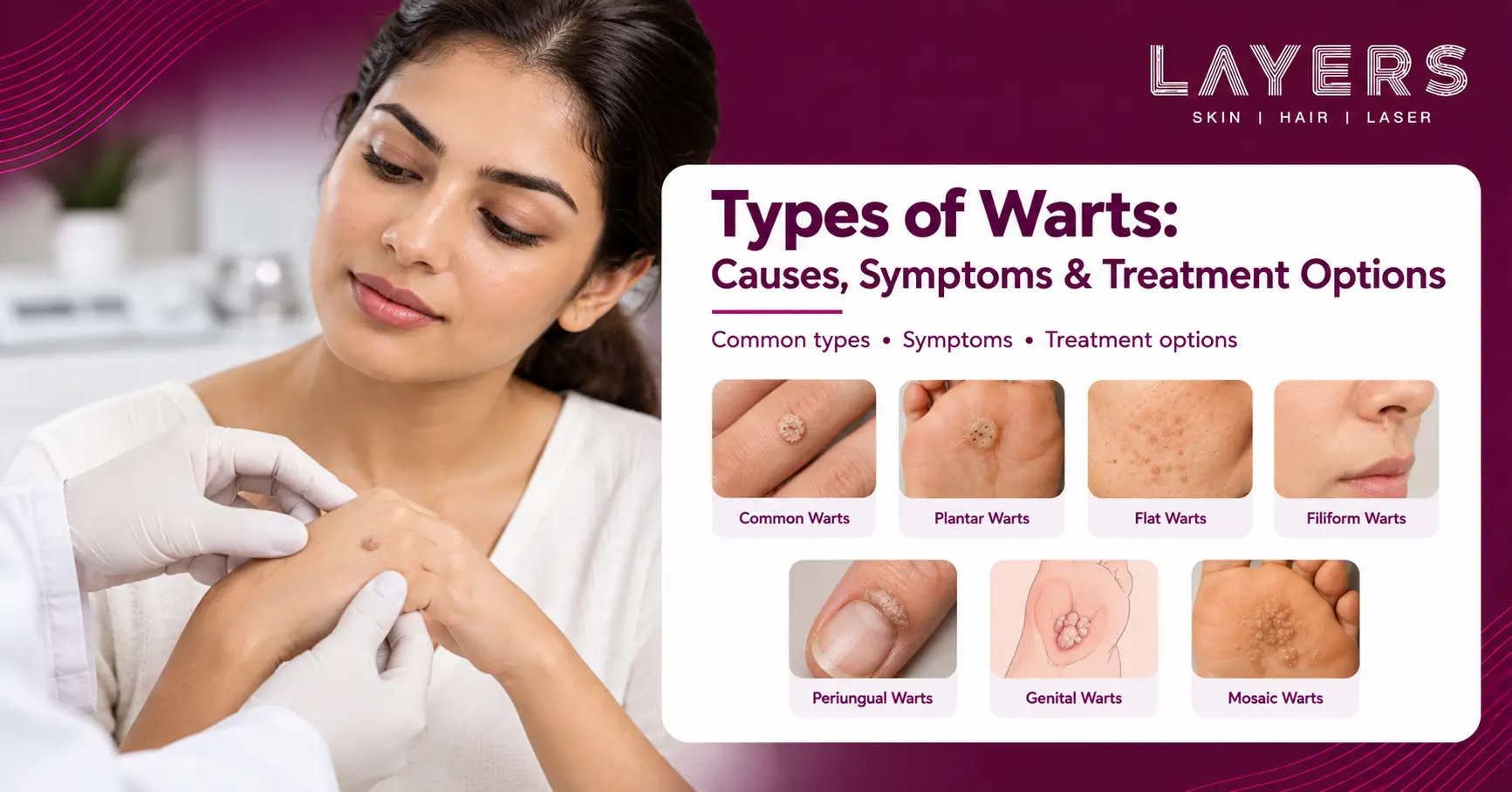 Types of Warts: Causes, Symptoms & Treatment Options
