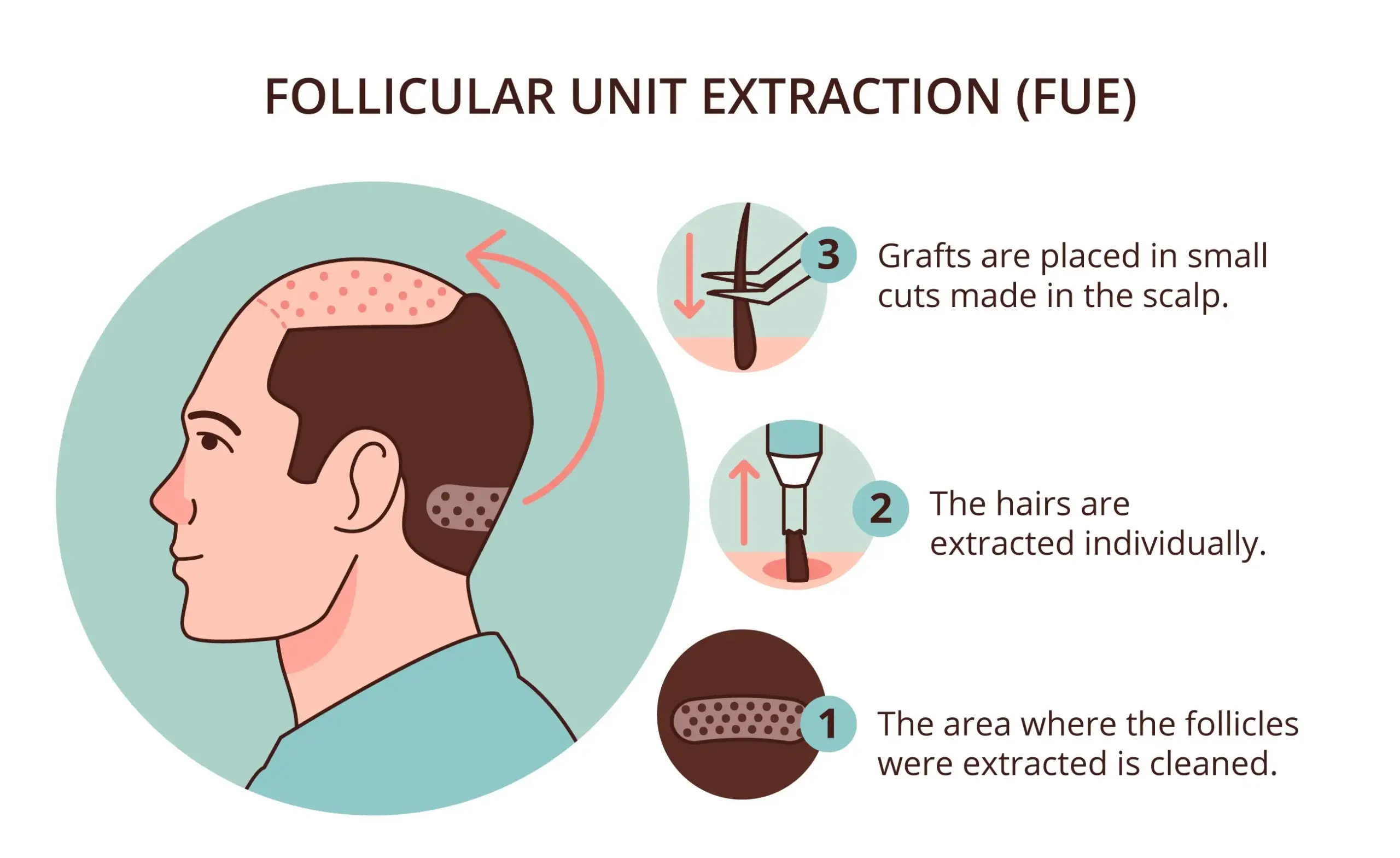 fue hair transplant technique showing graft extraction and natural hairline restoration