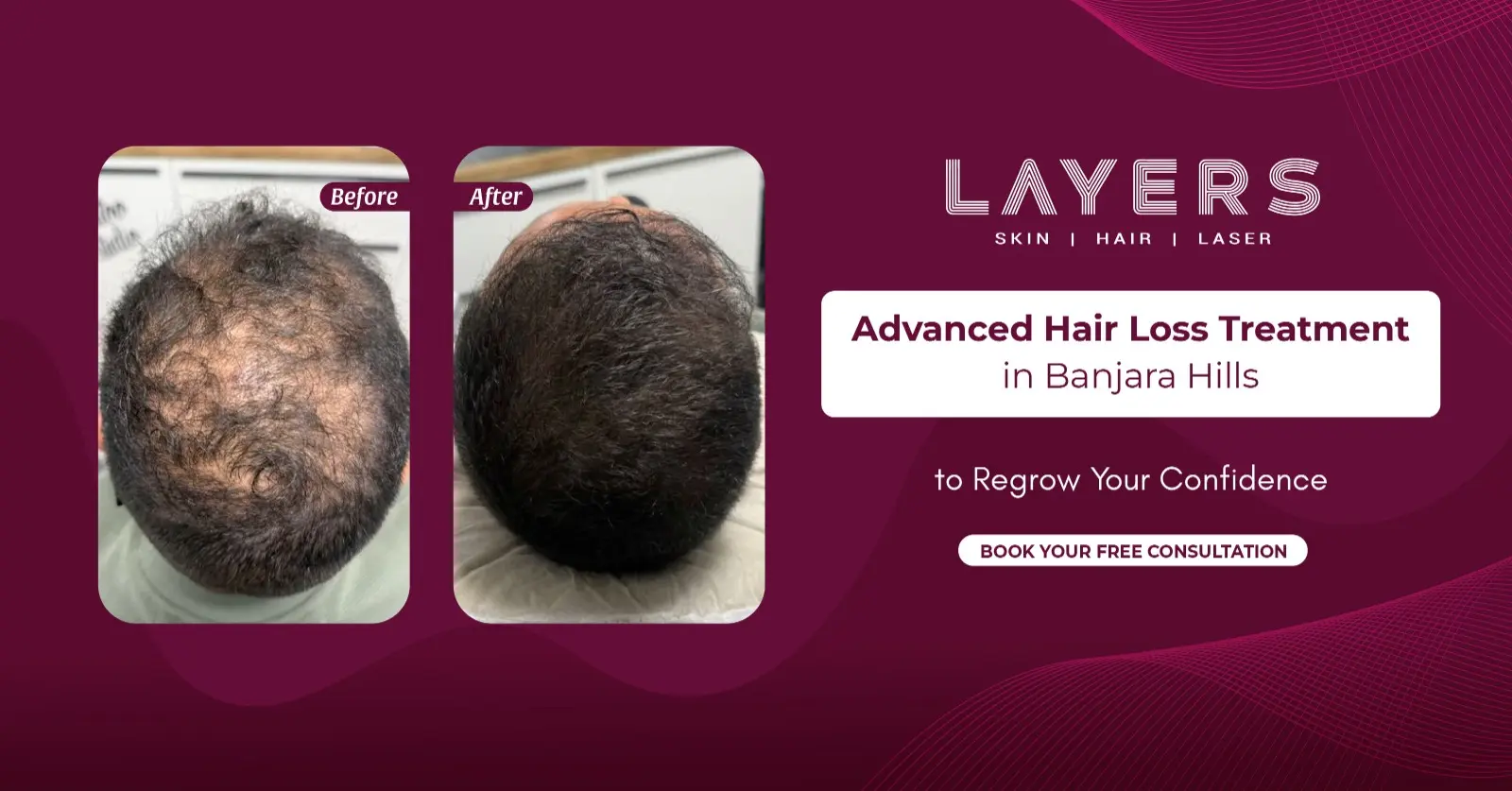 Hair Loss Treatment in Banjara Hills