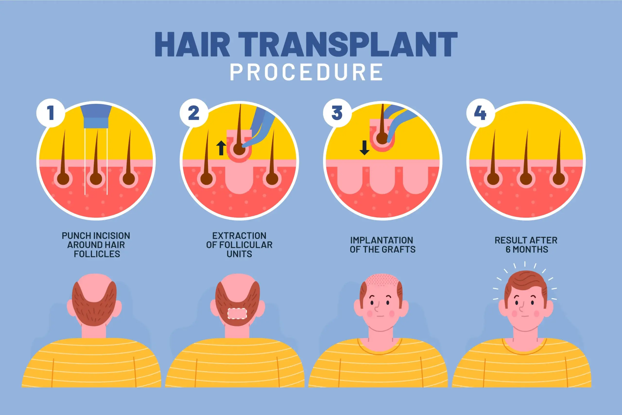 Best Hair Transplant Clinic in Bangalore