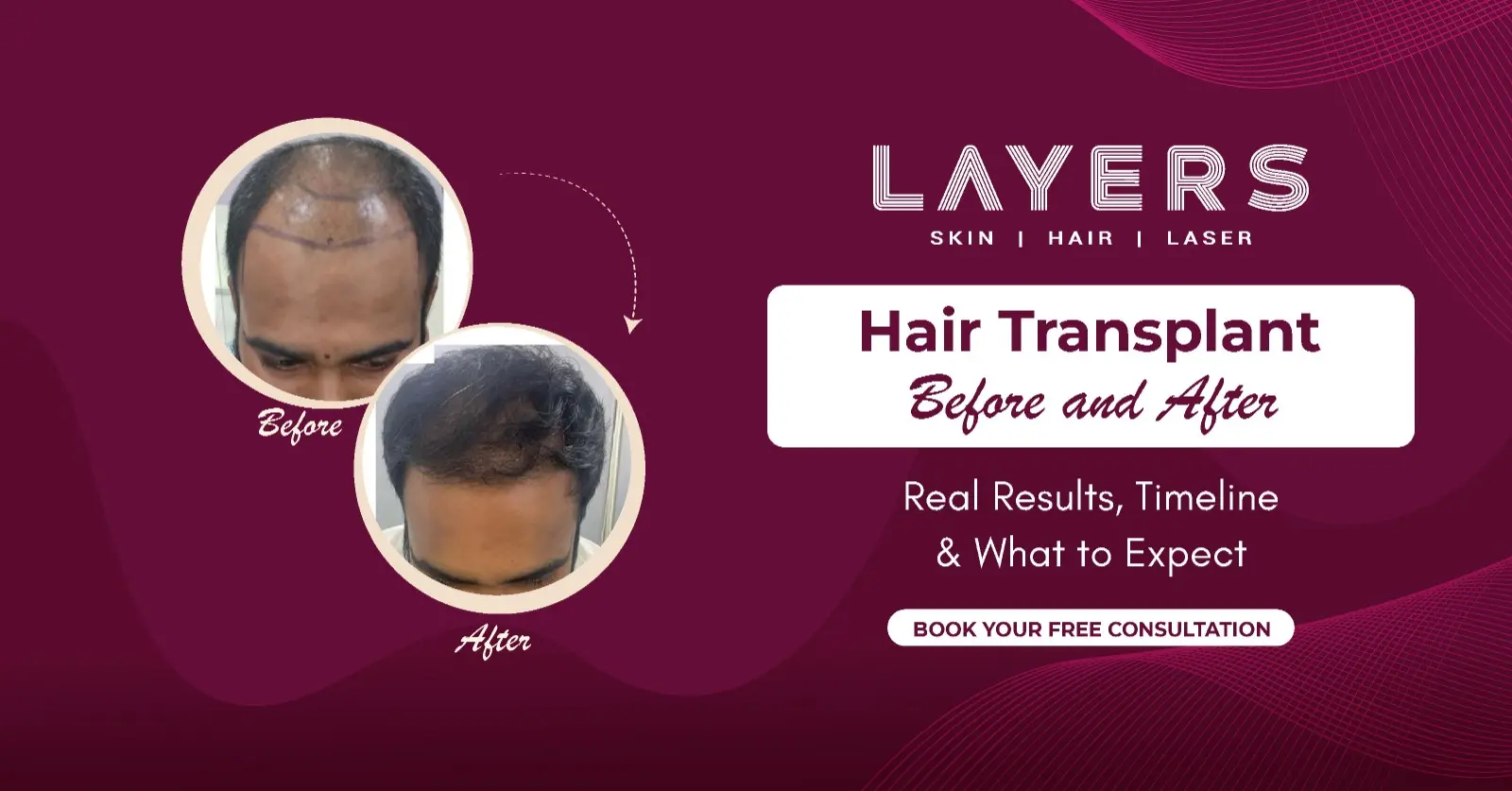 Hair Transplant Before and After: Real Results Photos