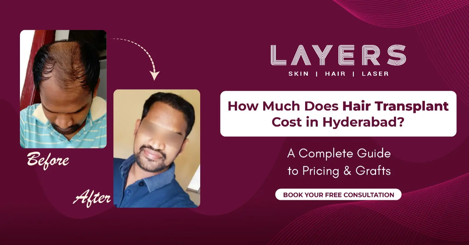 Hair Transplant Cost in Hyderabad