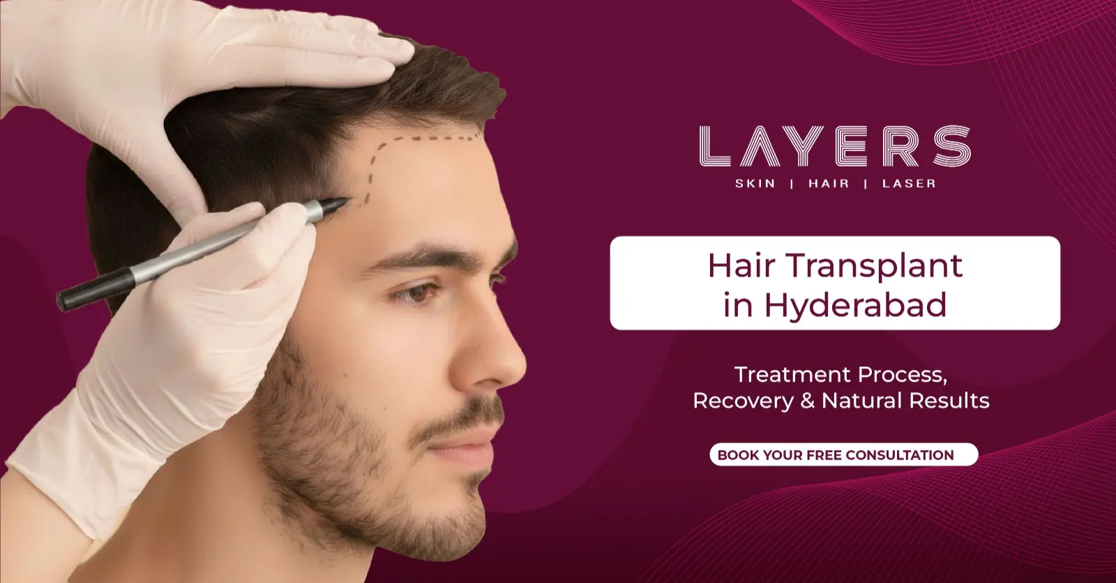 Hair Transplant in Hyderabad