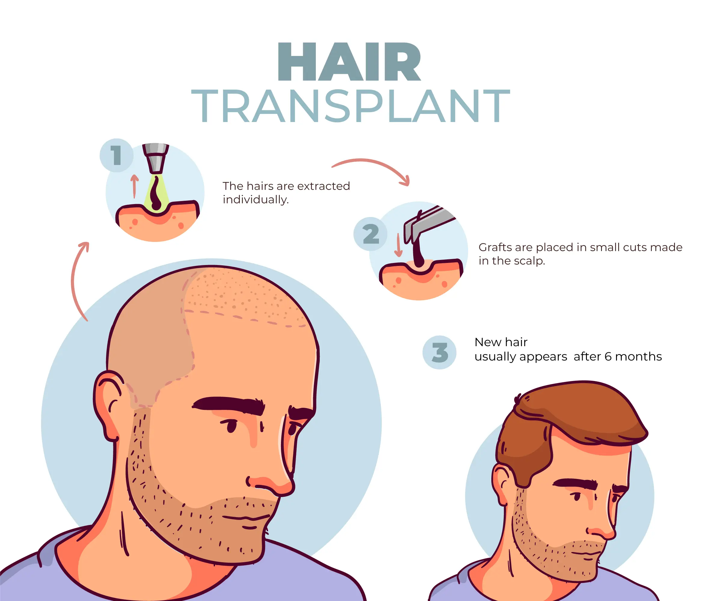 hair transplant methods explained with before and after baldness results