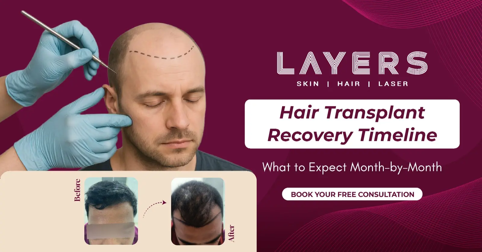Hair Transplant Recovery Timeline What to Expect Month-by-Month