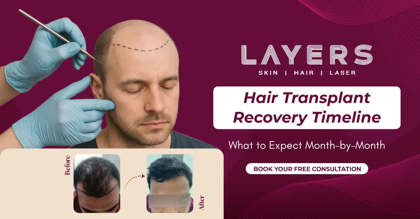 Hair Transplant Recovery Timeline