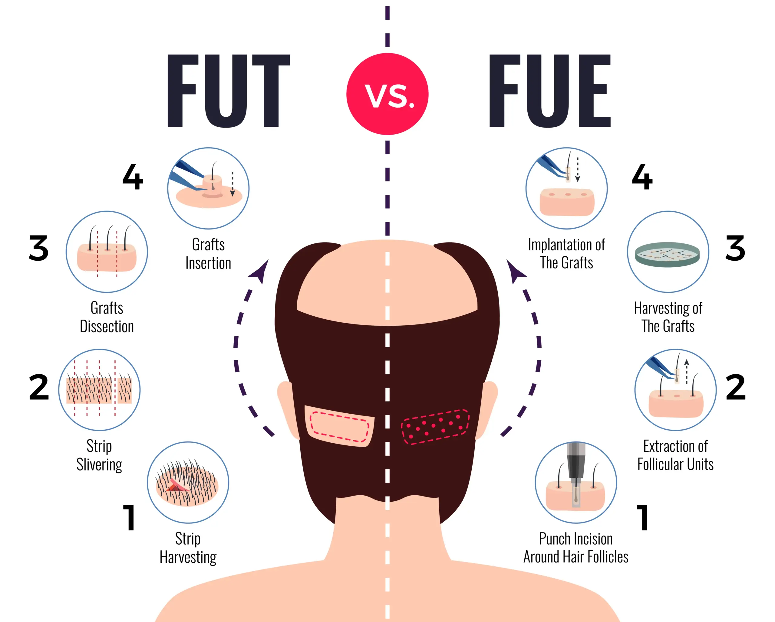 Hair transplant techniques comparison showing FUE vs FUT procedure for hair loss treatment