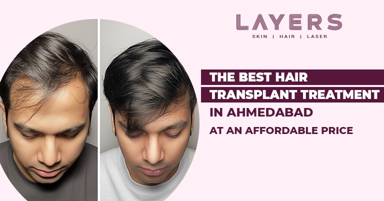 Hair transplant treatment in ahmedabad