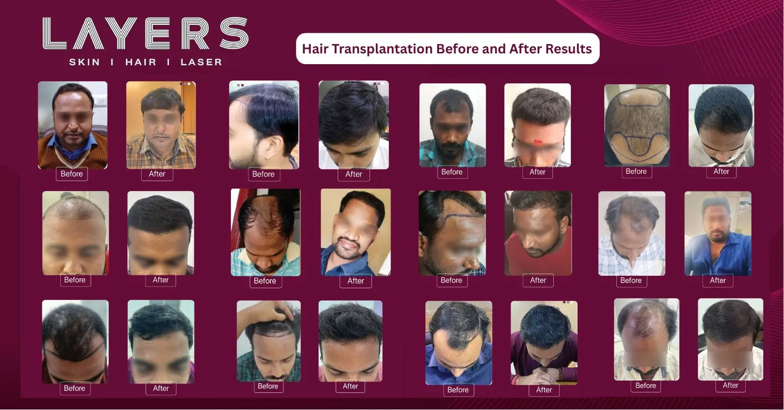 Hair Transplantation Before and After Results Layers Clinics 7211+ Successful Transformations