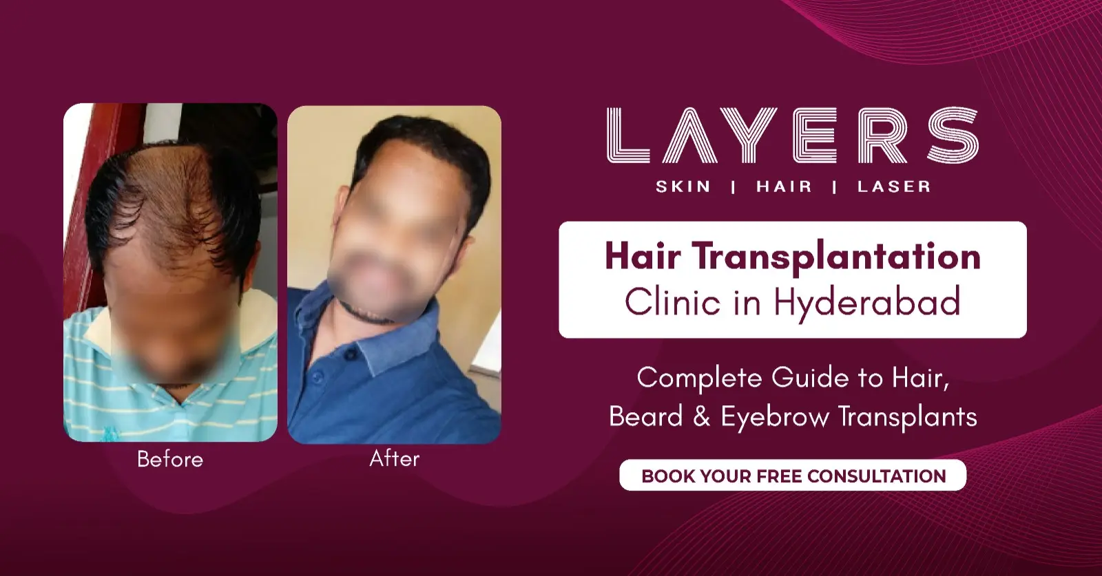 Hair Transplantation Clinic in Hyderabad Complete Guide to Hair, Beard & Eyebrow Transplants