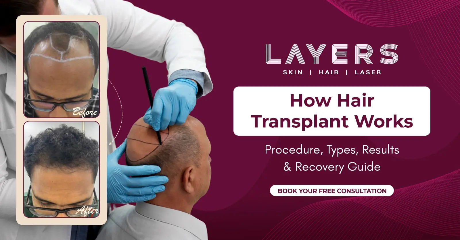 How Hair Transplant Works Procedure, Recovery & Results