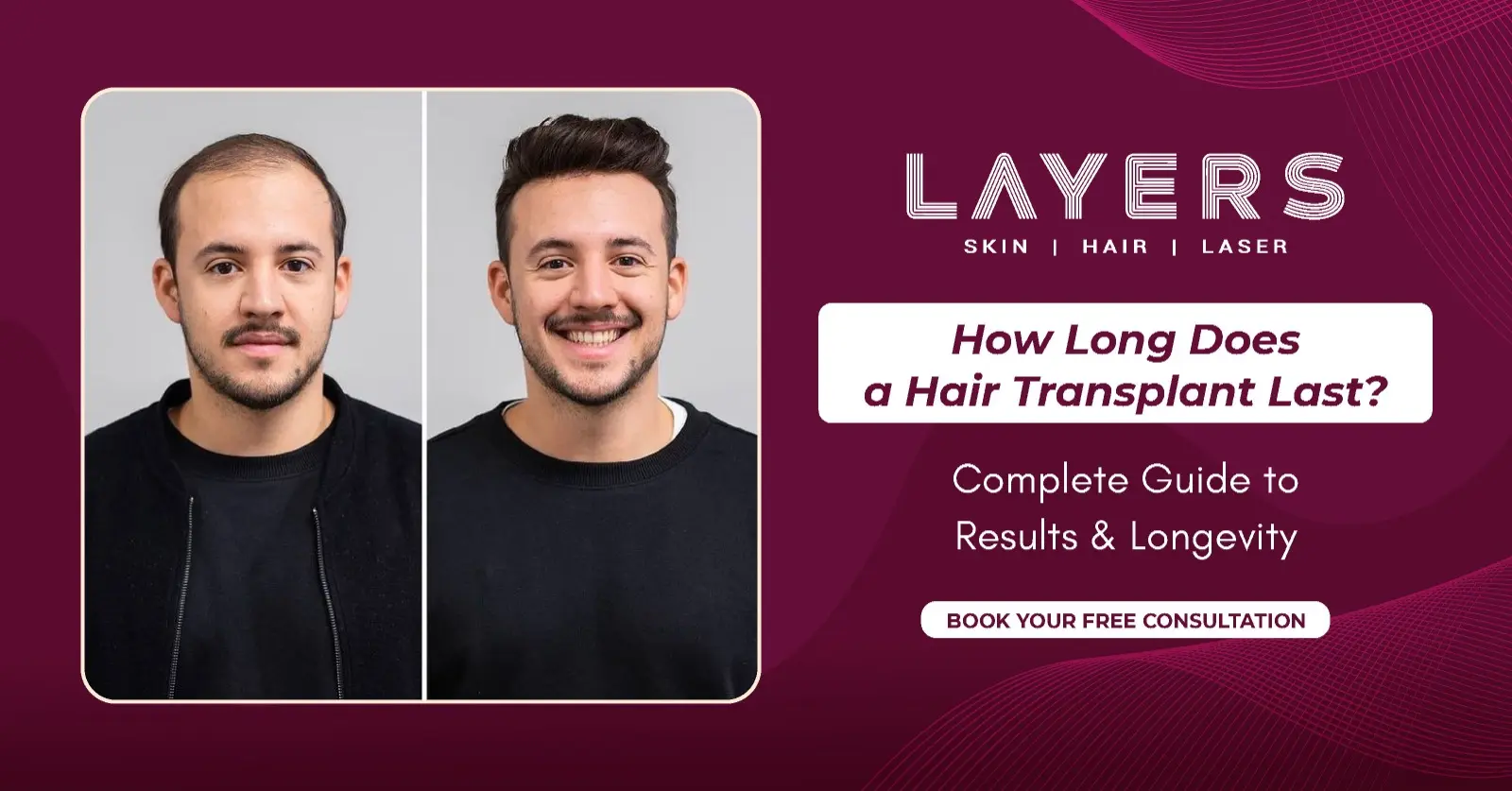 How Long Does Hair Transplant Last