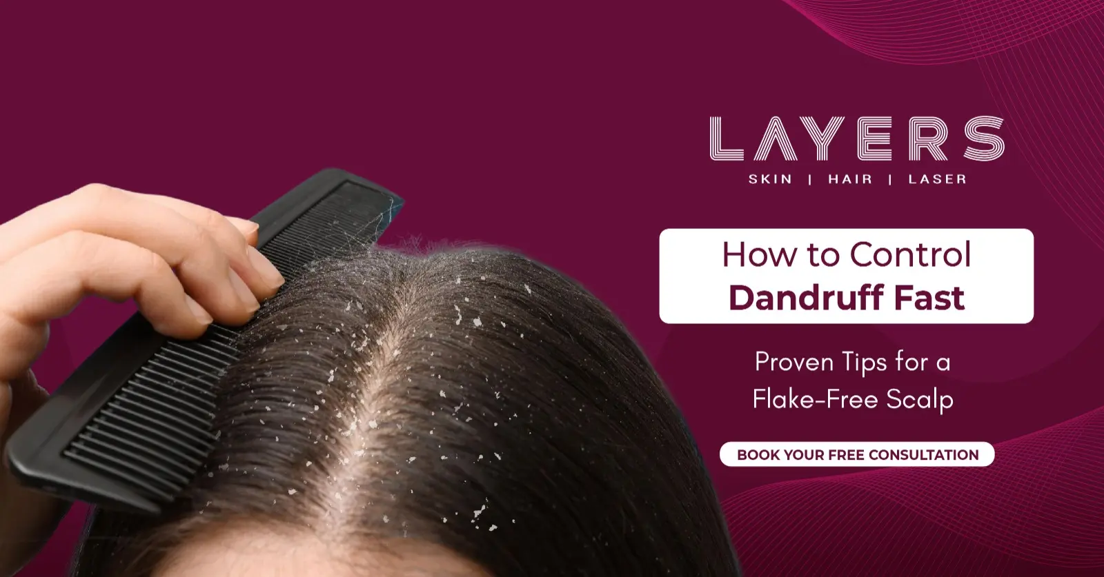 How to Control Dandruff Fast