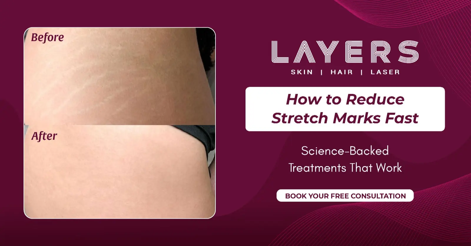 How to Reduce Stretch Marks Permanently