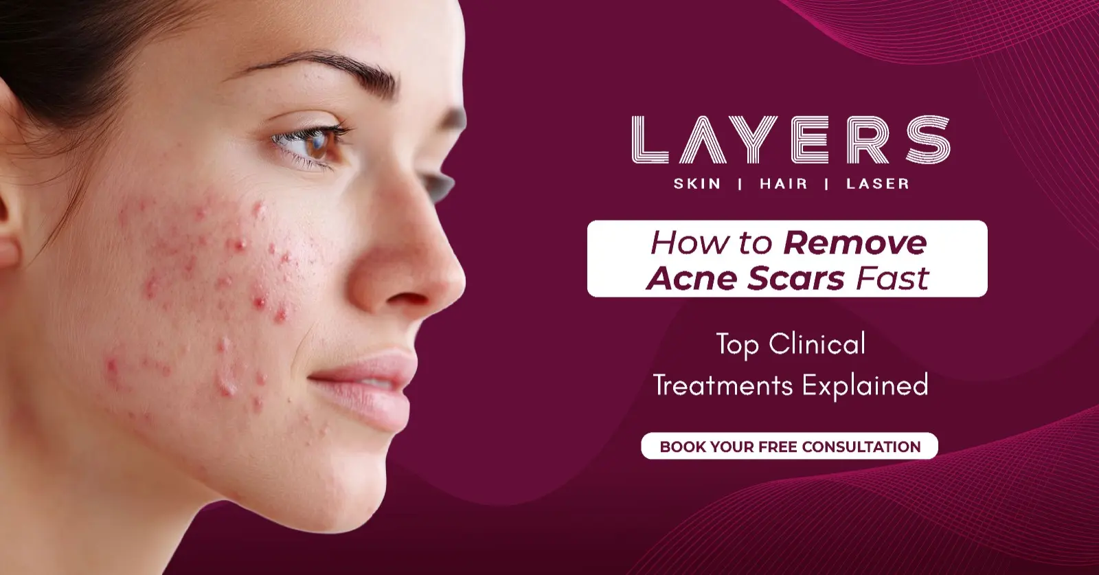 How to Remove Acne Scars