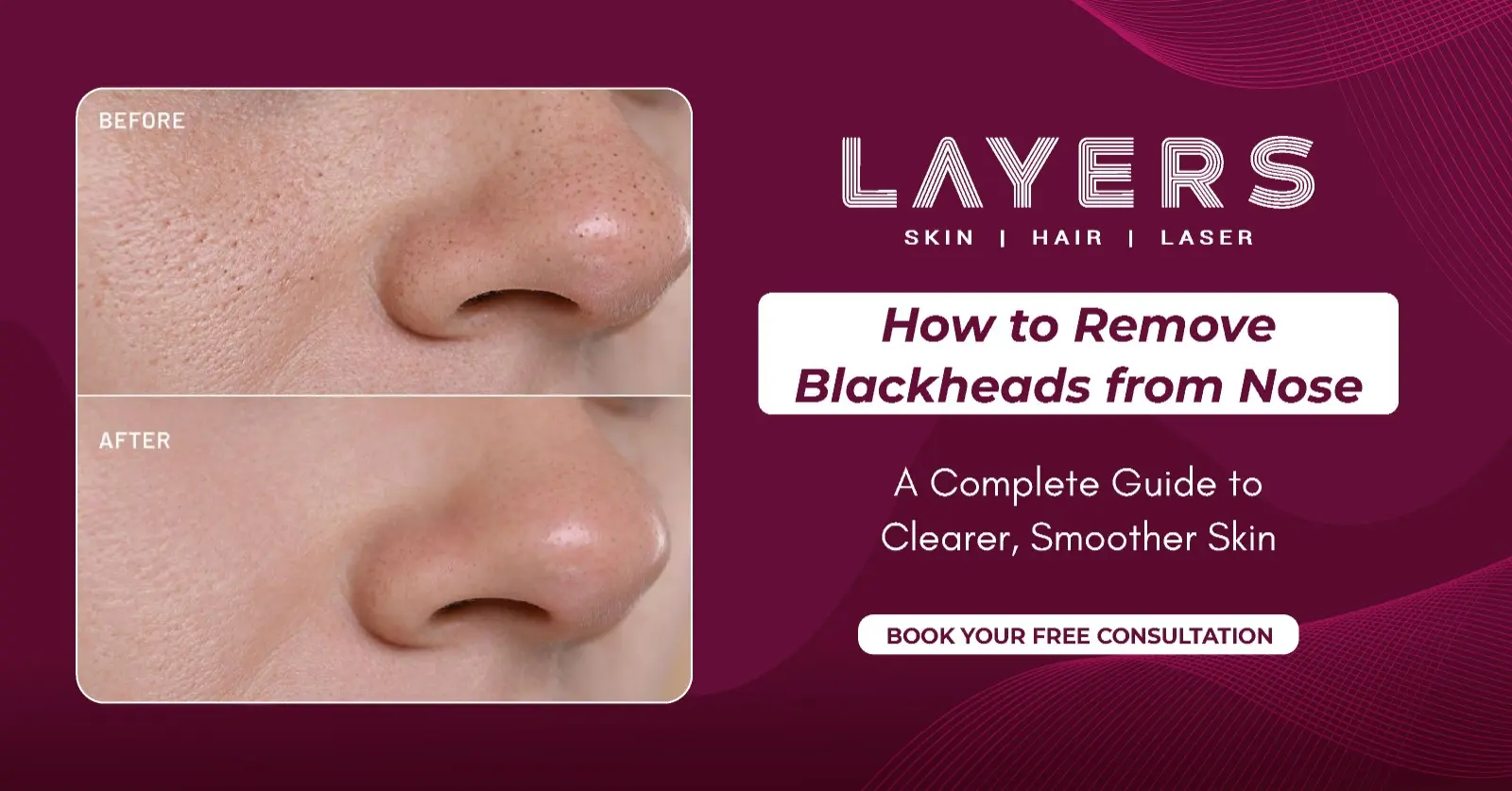 How to Remove Blackheads from Nose
