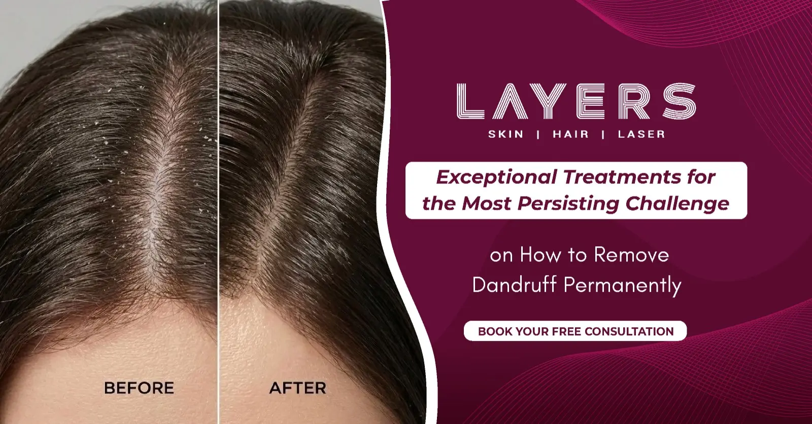 How to Remove Dandruff Permanently