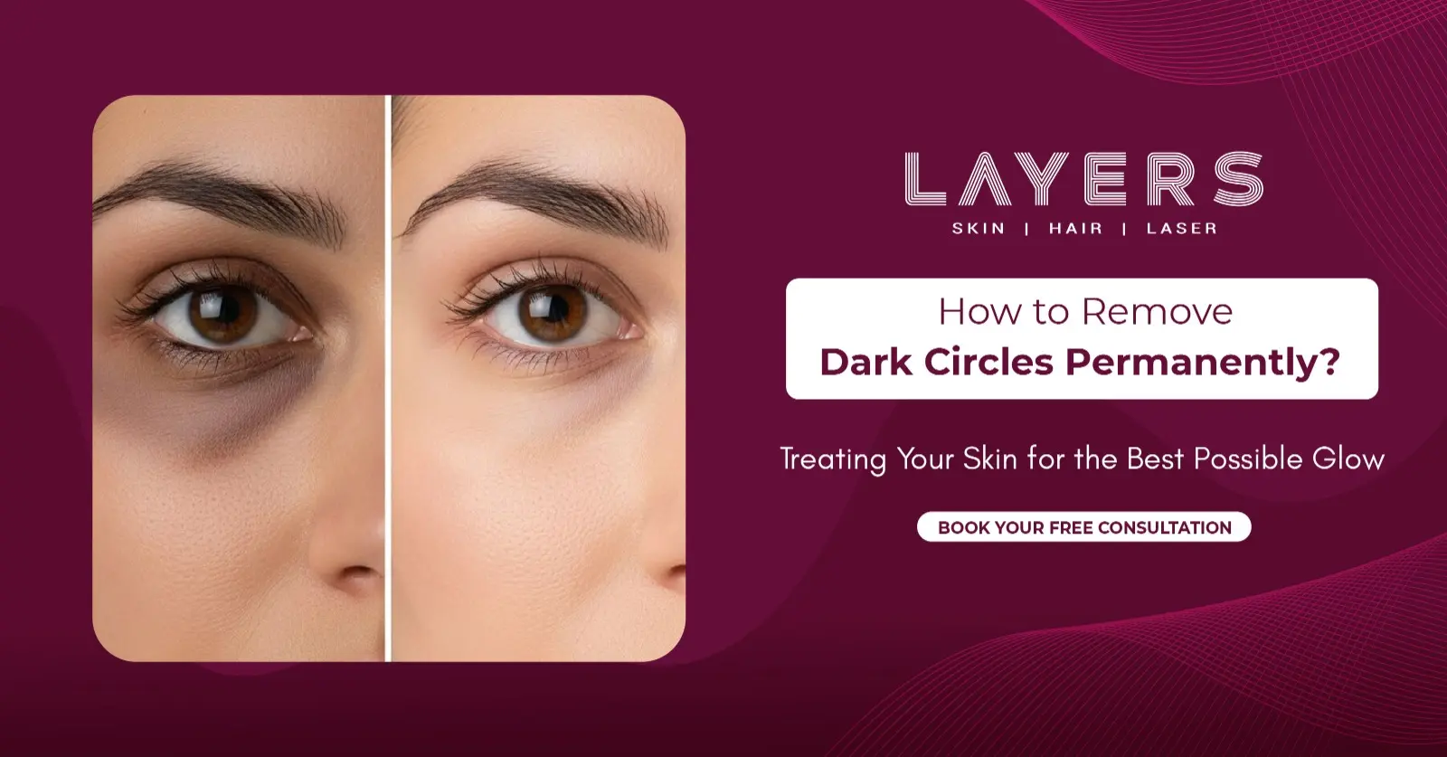 How to Remove Dark Circles Permanently