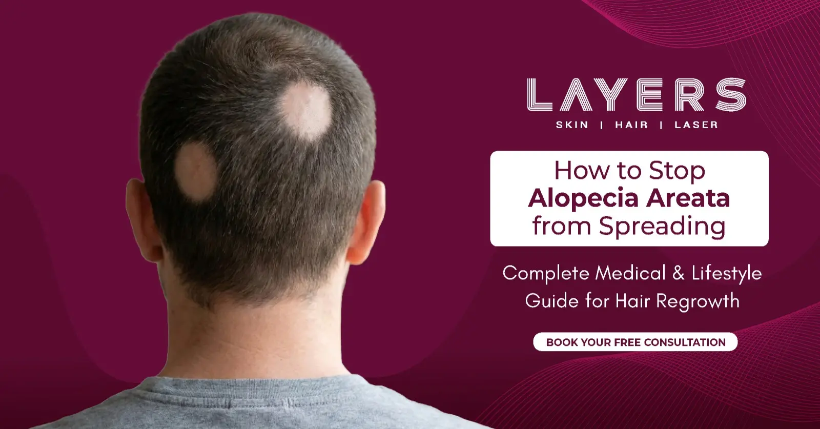 How to Stop Alopecia Areata from Spreading