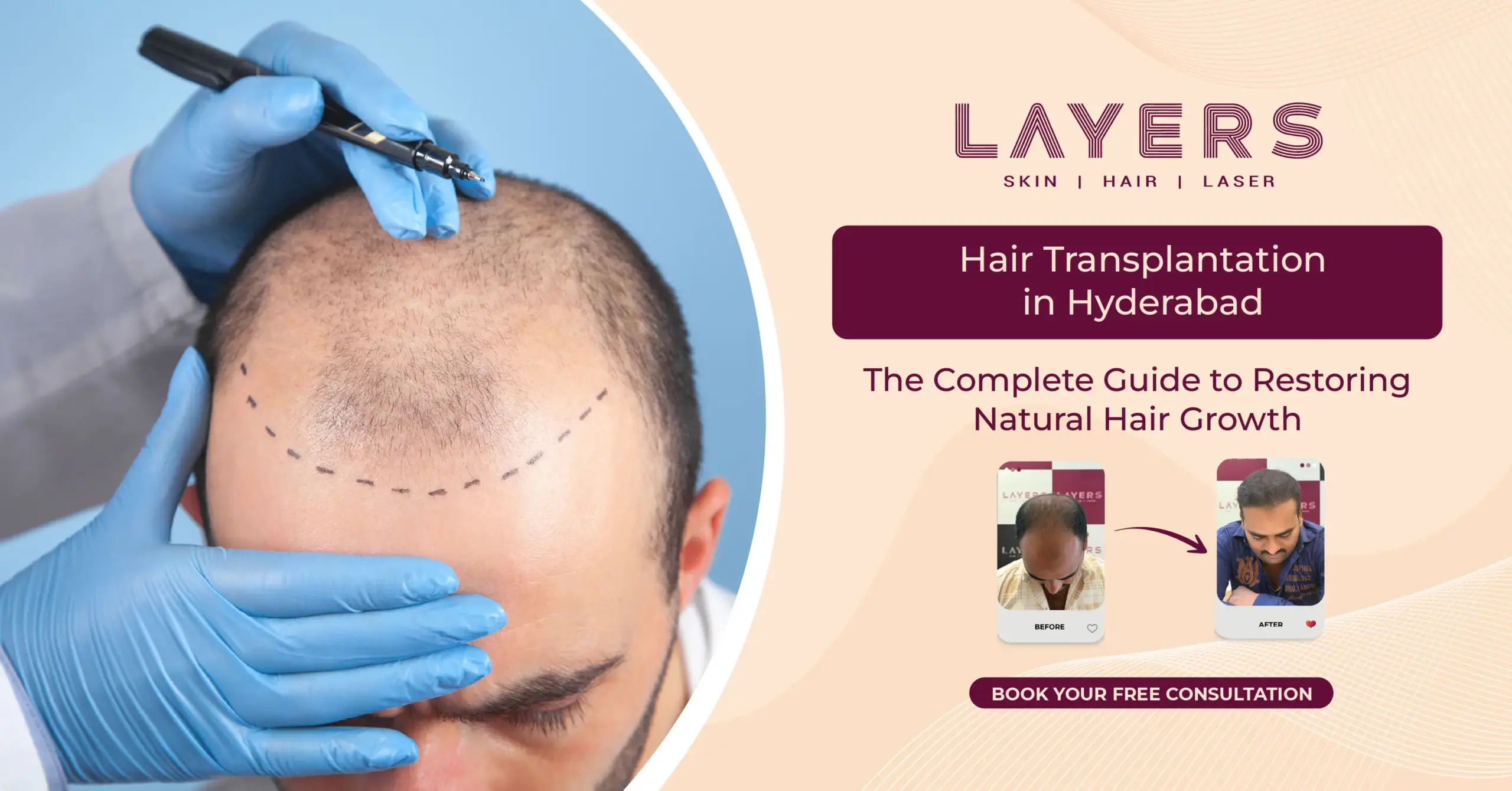 hair transplantation in Hyderabad