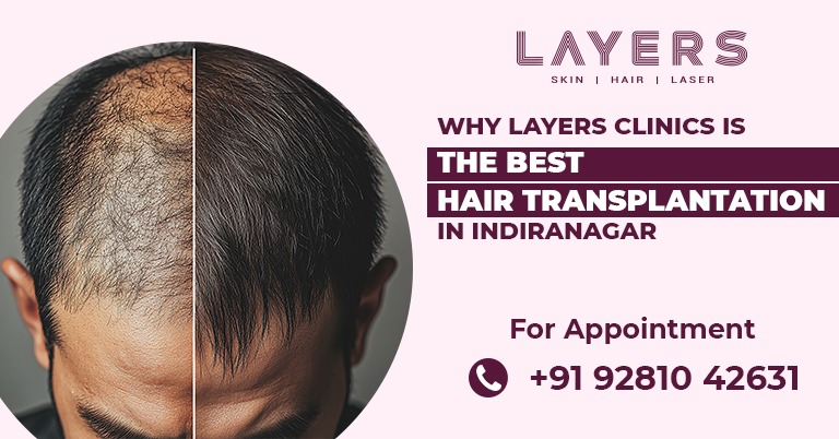 Hair Transplant in Indiranagar
