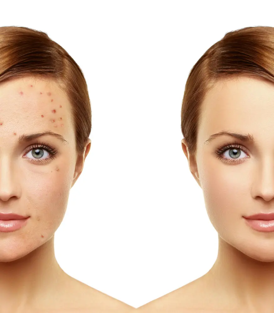 Pigmentation