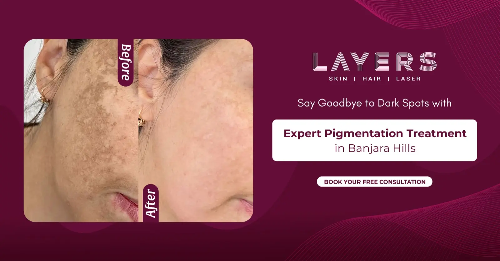 Pigmentation Treatment in Banjara Hills
