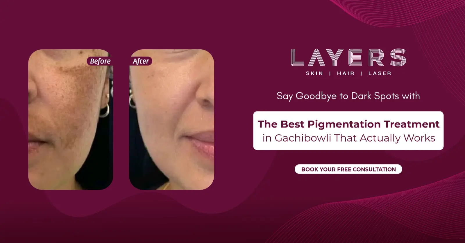 Pigmentation Treatment in Gachibowli