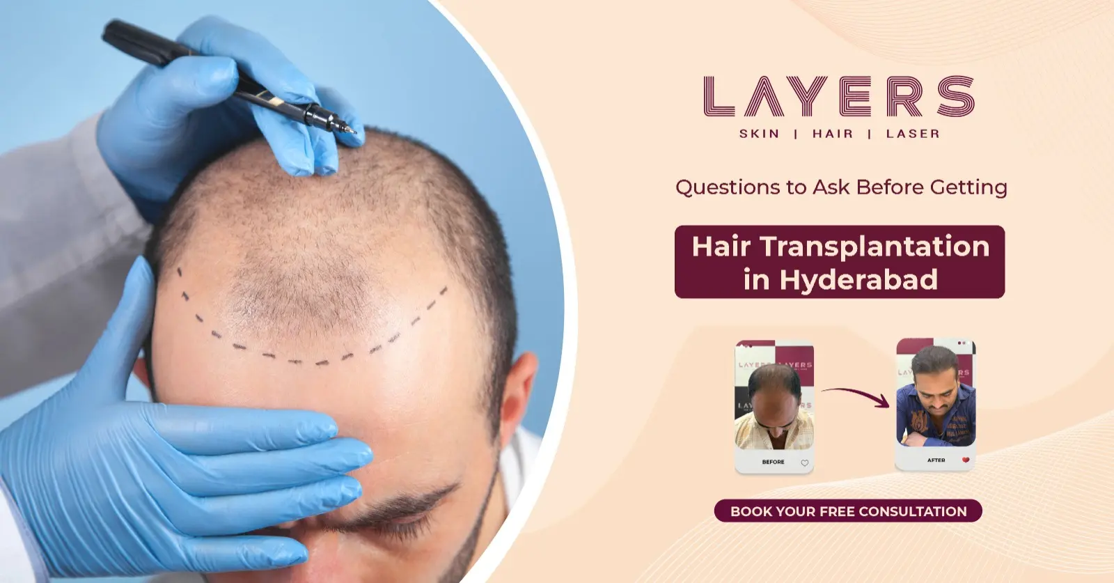 Questions to Ask Before Getting Hair Transplantation in Hyderabad