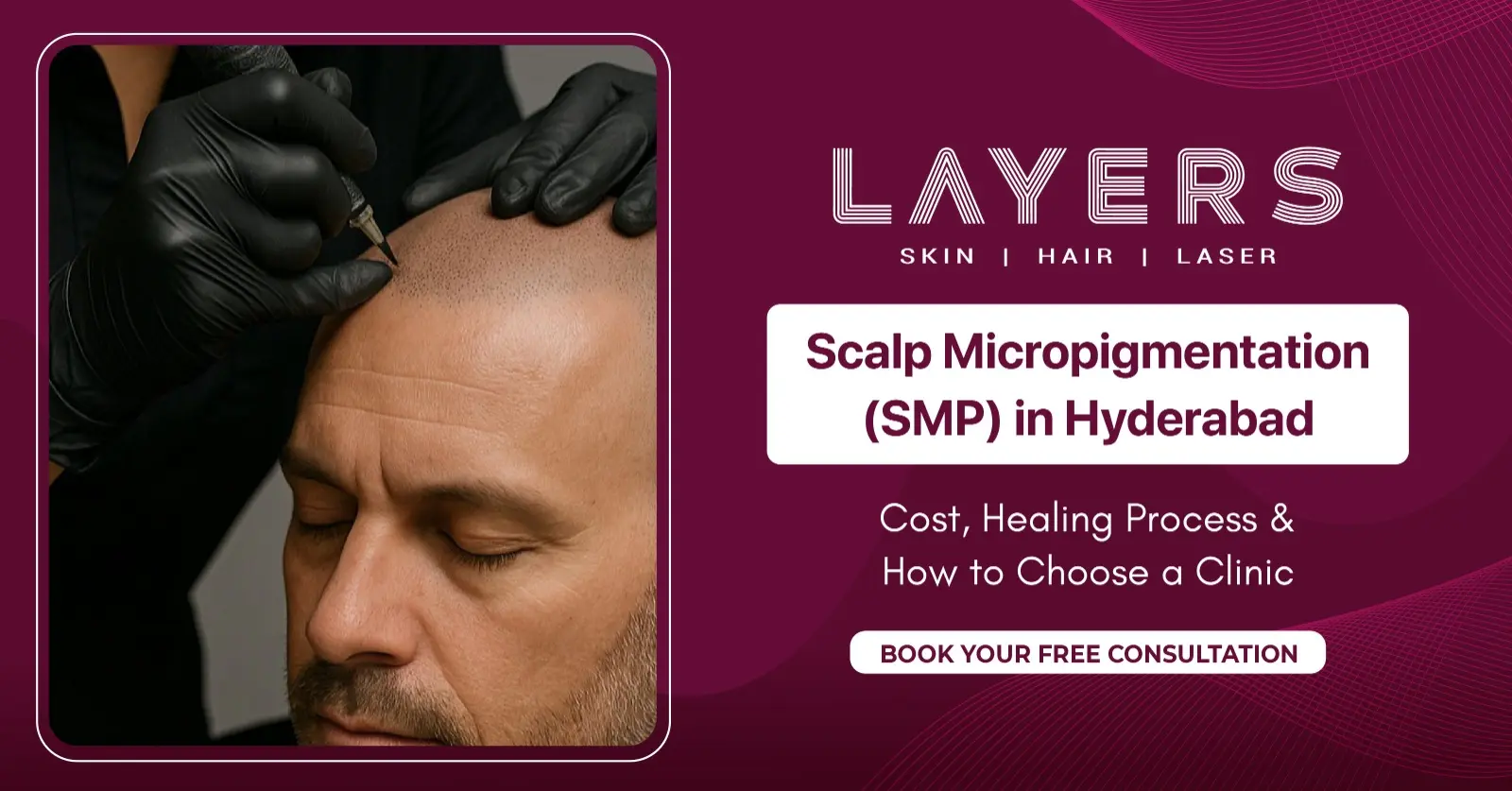 scalp-micropigmentation in hyderabad cost healing-process how to choose the best clinic