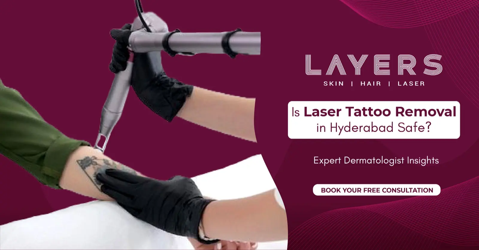 Tattoo Removal in Hyderabad