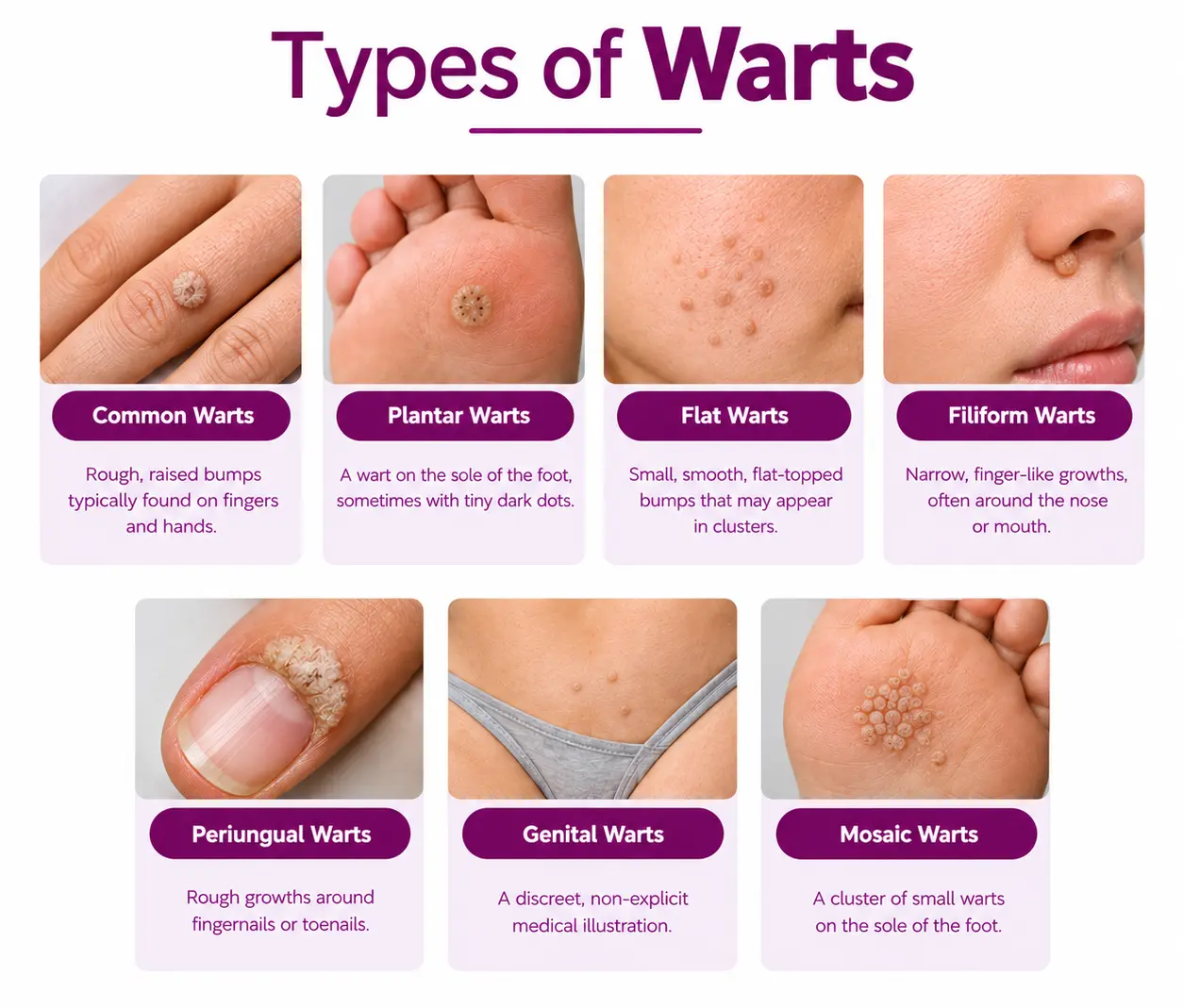 Types of Warts: Causes, Symptoms & Treatment Options