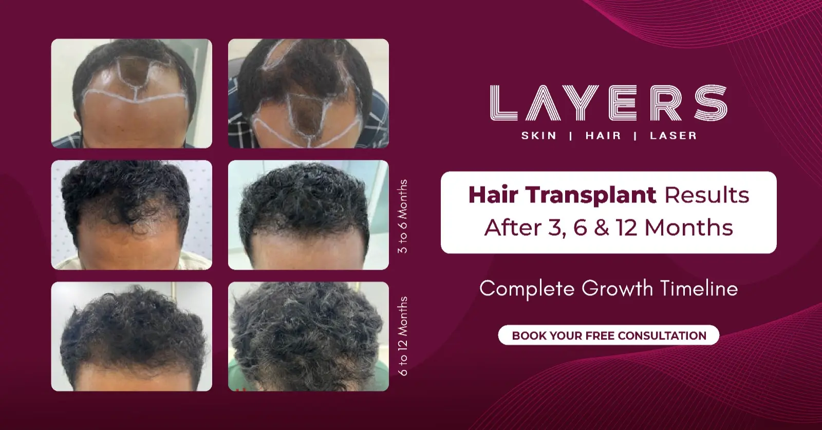 Hair Transplant Results After 3, 6 & 12 Months: Complete Growth Timeline