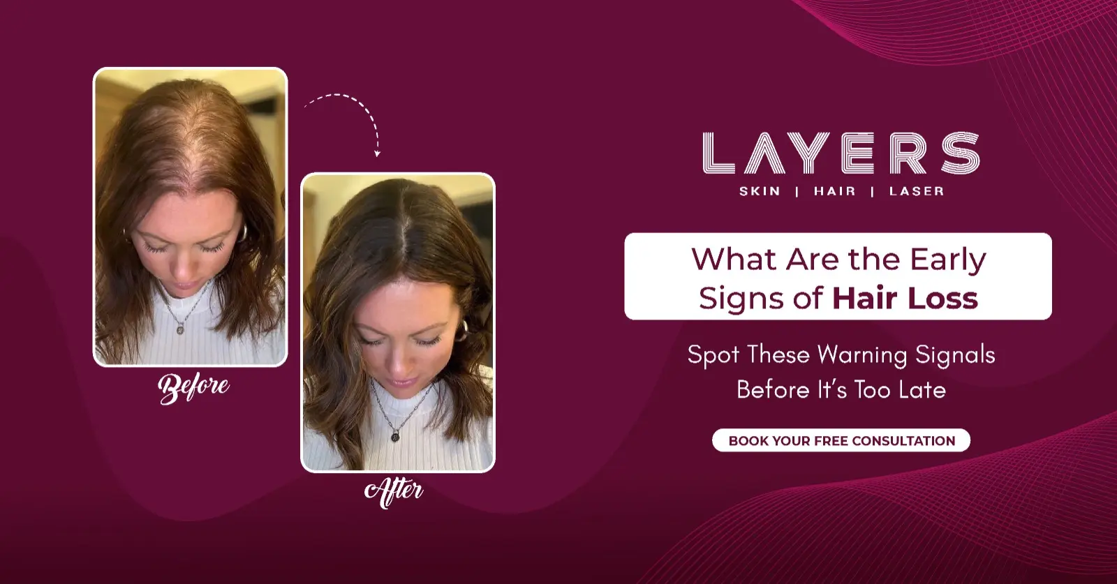 What Are the Early Signs of Hair Loss