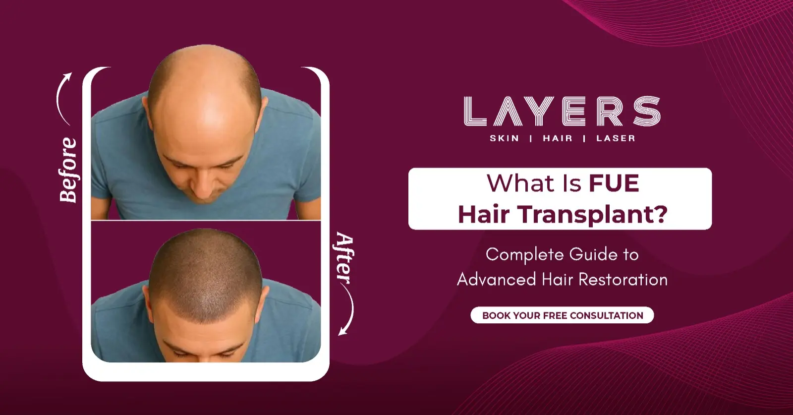 What Is FUE Hair Transplant