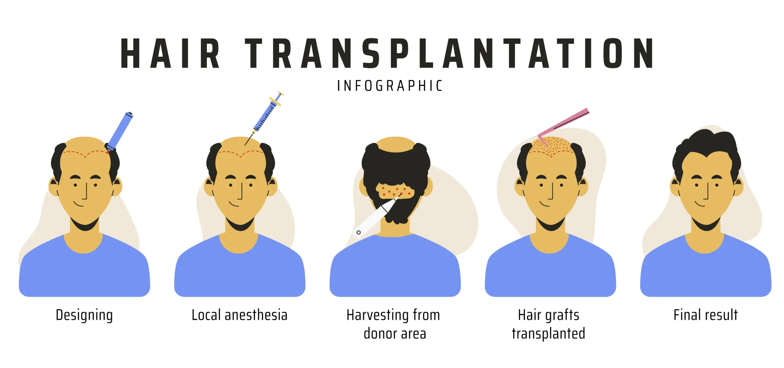 What is Hair Transplantation