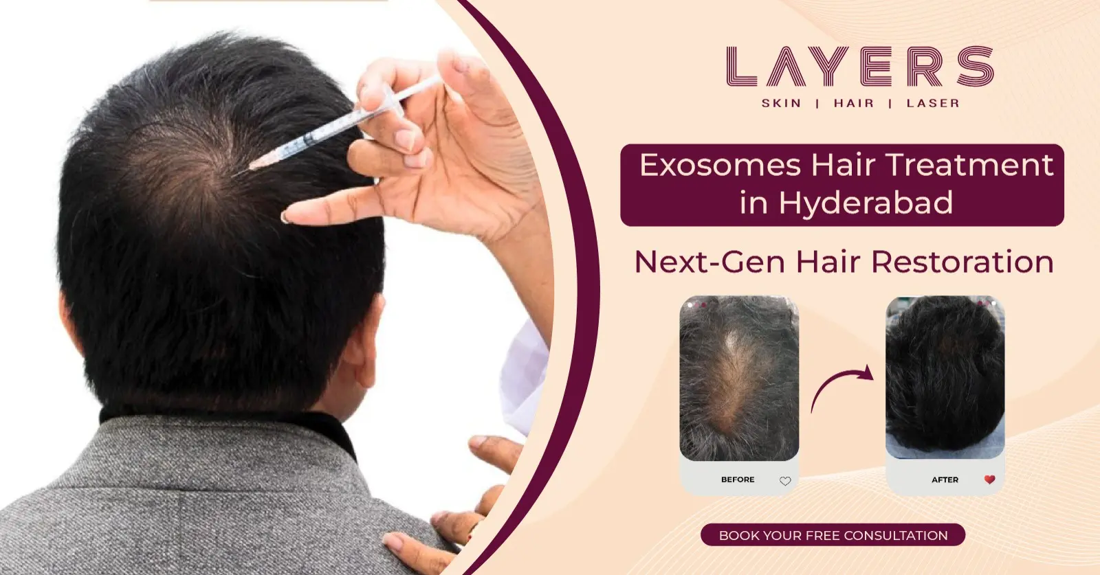 Exosomes Hair Treatment in Hyderabad